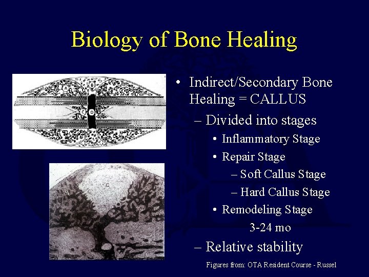 Biology of Bone Healing • Indirect/Secondary Bone Healing = CALLUS – Divided into stages