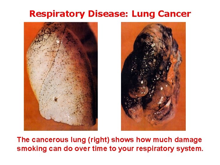 Respiratory Disease: Lung Cancer The cancerous lung (right) shows how much damage smoking can Respiratory Disease: Lung Cancer The cancerous lung (right) shows how much damage smoking can