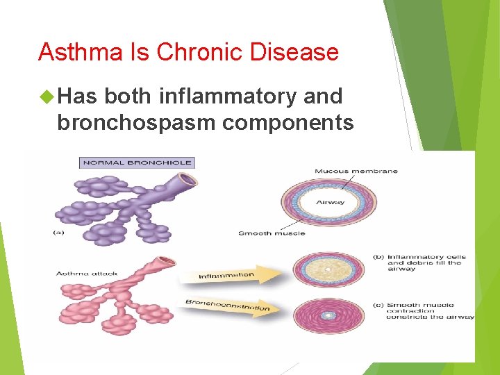 Asthma Is Chronic Disease Has both inflammatory and bronchospasm components 