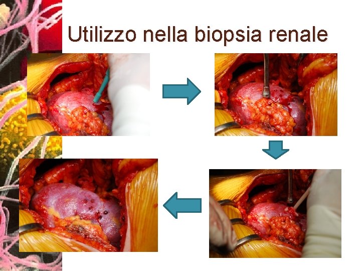 Utilizzo nella biopsia renale 