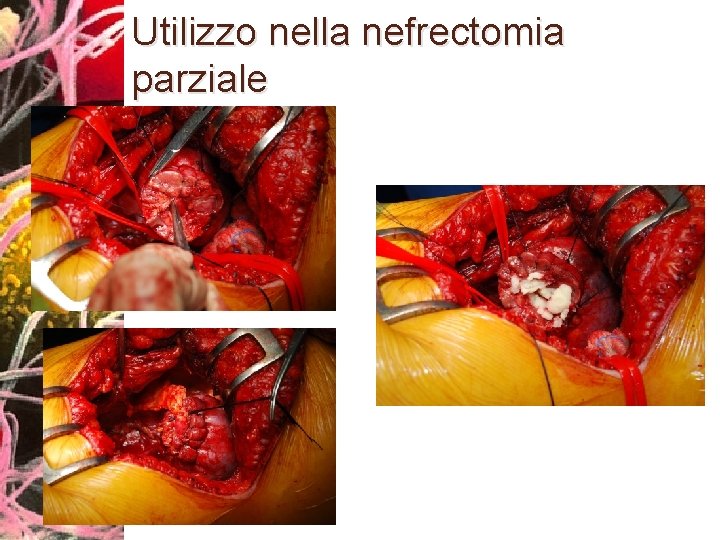 Utilizzo nella nefrectomia parziale 