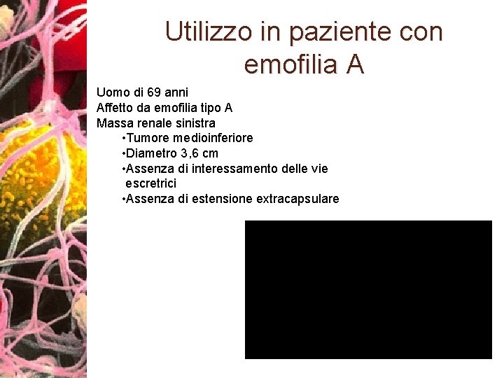 Utilizzo in paziente con emofilia A Uomo di 69 anni Affetto da emofilia tipo