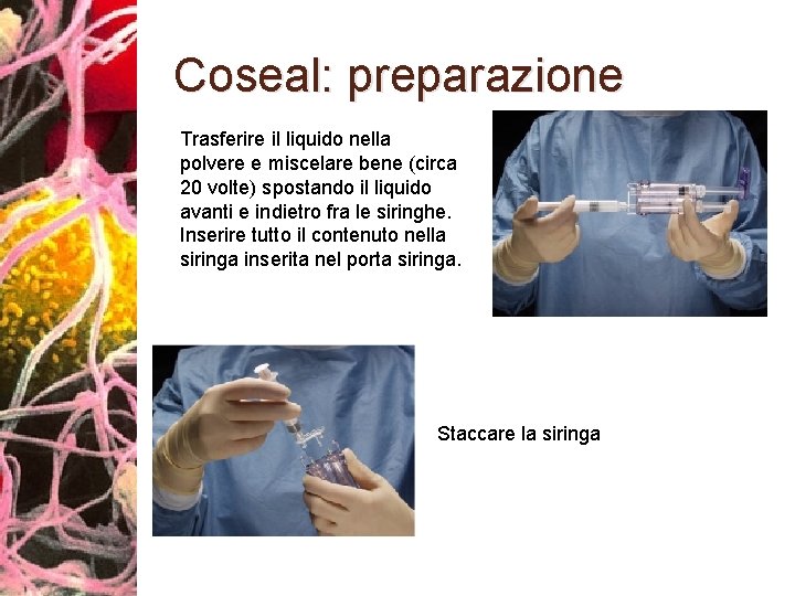 Coseal: preparazione Trasferire il liquido nella polvere e miscelare bene (circa 20 volte) spostando