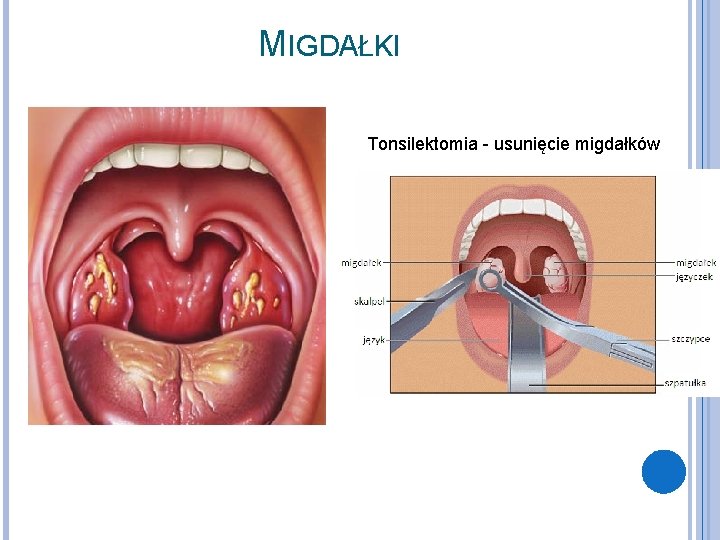 MIGDAŁKI Tonsilektomia - usunięcie migdałków 