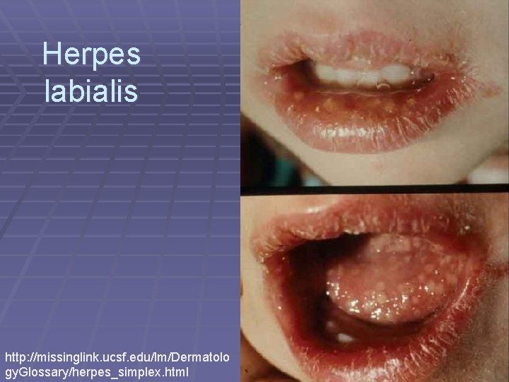 Herpes labialis http: //missinglink. ucsf. edu/lm/Dermatolo gy. Glossary/herpes_simplex. html 