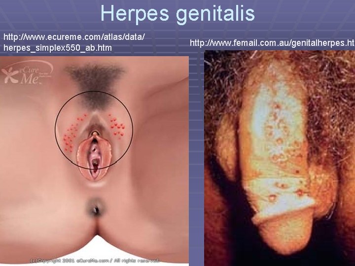 Herpes genitalis http: //www. ecureme. com/atlas/data/ herpes_simplex 550_ab. htm http: //www. femail. com. au/genitalherpes.