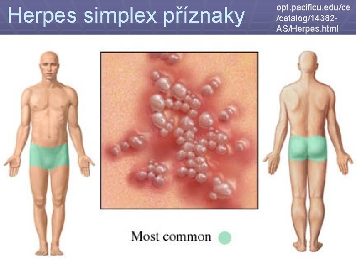 Herpes simplex příznaky opt. pacificu. edu/ce /catalog/14382 AS/Herpes. html 