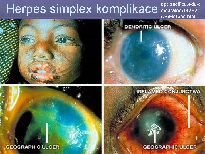 Herpes simplex komplikace opt. pacificu. edu/c e/catalog/14382 AS/Herpes. html. 
