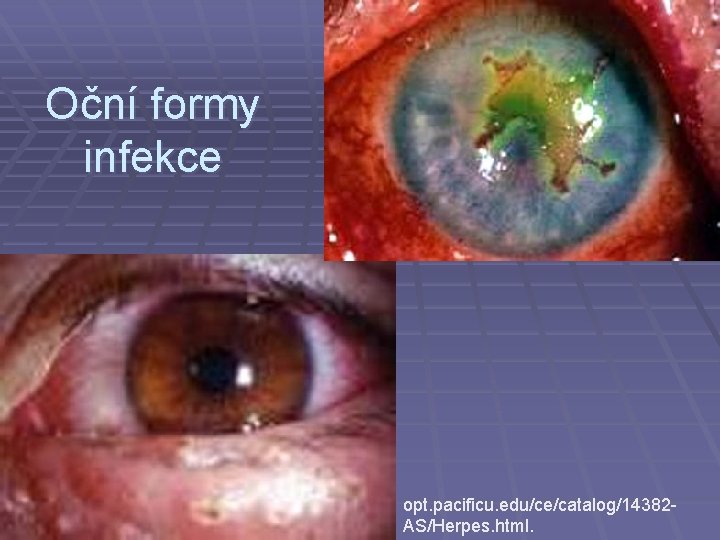 Oční formy infekce opt. pacificu. edu/ce/catalog/14382 AS/Herpes. html. 