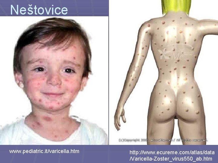 Neštovice www. pediatric. it/varicella. htm http: //www. ecureme. com/atlas/data /Varicella-Zoster_virus 550_ab. htm 