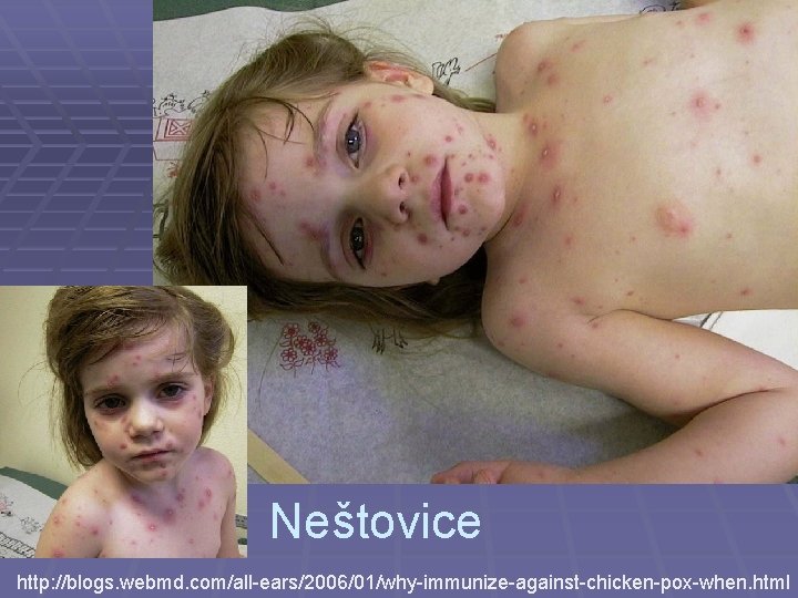 Neštovice http: //blogs. webmd. com/all-ears/2006/01/why-immunize-against-chicken-pox-when. html 