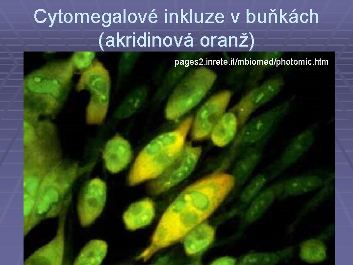 Cytomegalové inkluze v buňkách (akridinová oranž) pages 2. inrete. it/mbiomed/photomic. htm 