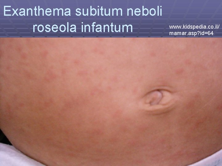 Exanthema subitum neboli www. kidspedia. co. il/ roseola infantum mamar. asp? id=64 