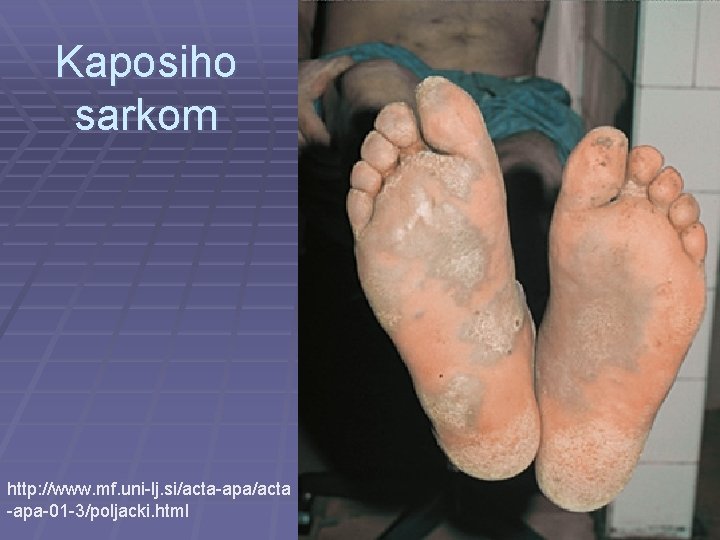 Kaposiho sarkom http: //www. mf. uni-lj. si/acta-apa/acta -apa-01 -3/poljacki. html 