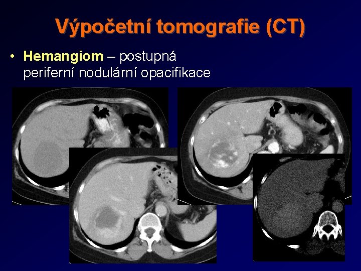 Výpočetní tomografie (CT) • Hemangiom – postupná periferní nodulární opacifikace 