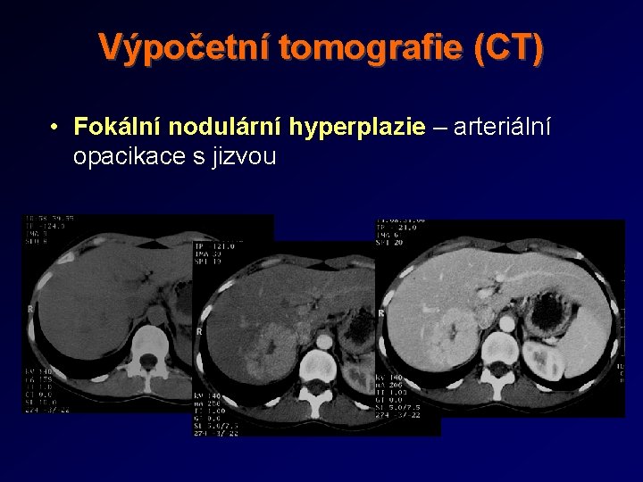 Výpočetní tomografie (CT) • Fokální nodulární hyperplazie – arteriální opacikace s jizvou Výpočetní tomografie (CT) • Fokální nodulární hyperplazie – arteriální opacikace s jizvou