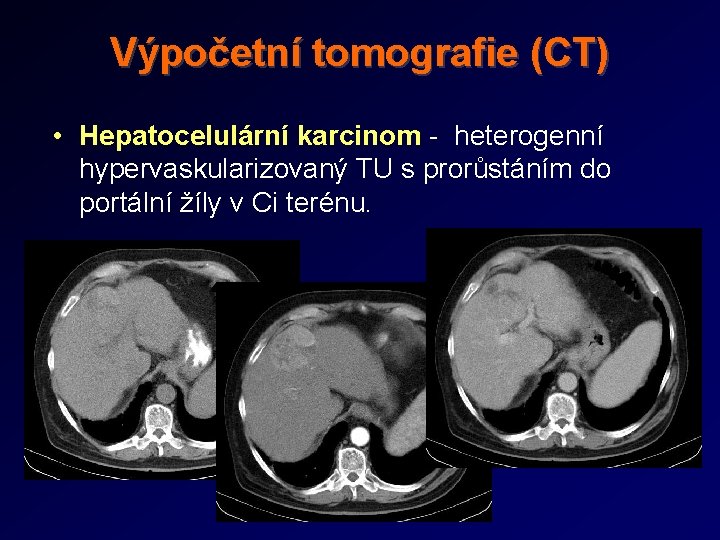 Výpočetní tomografie (CT) • Hepatocelulární karcinom - heterogenní hypervaskularizovaný TU s prorůstáním do portální