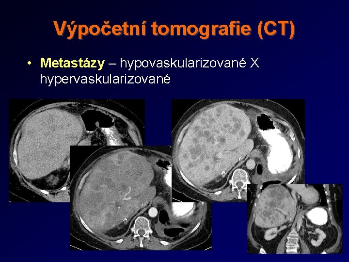 Výpočetní tomografie (CT) • Metastázy – hypovaskularizované X hypervaskularizované 
