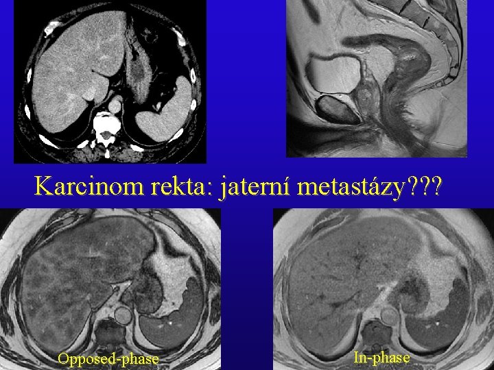 Karcinom rekta: jaterní metastázy? ? ? Opposed-phase In-phase Karcinom rekta: jaterní metastázy? ? ? Opposed-phase In-phase