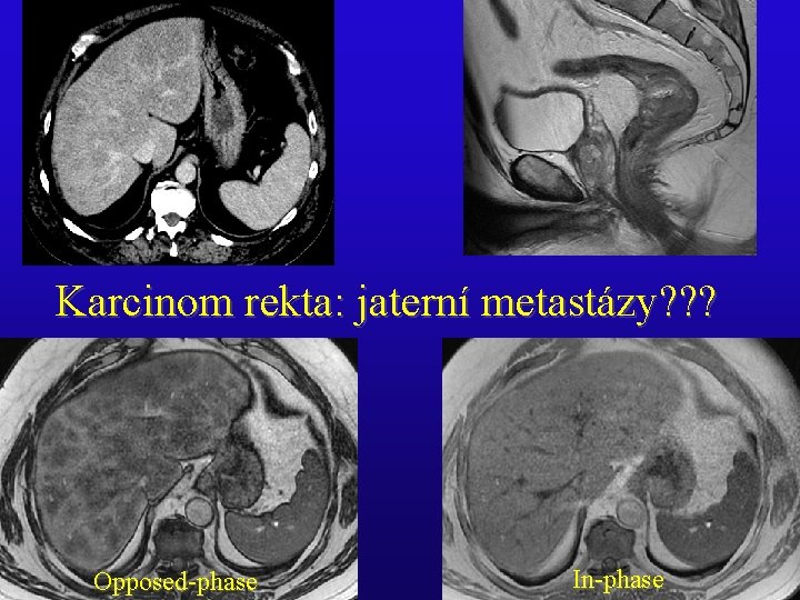 Karcinom rekta: jaterní metastázy? ? ? Opposed-phase In-phase 