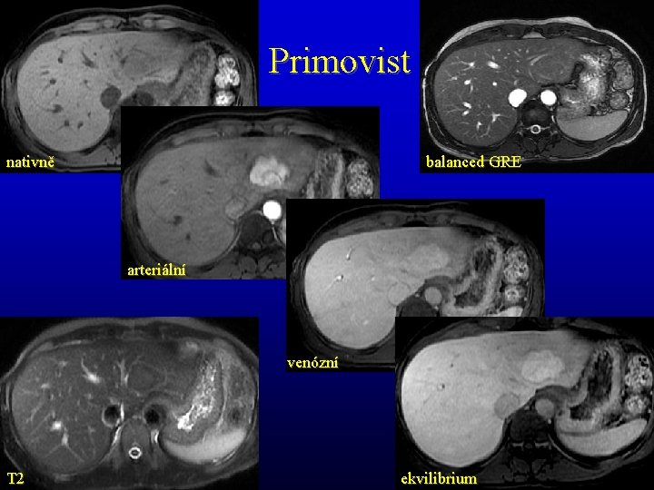 Primovist nativně balanced GRE arteriální venózní T 2 ekvilibrium 