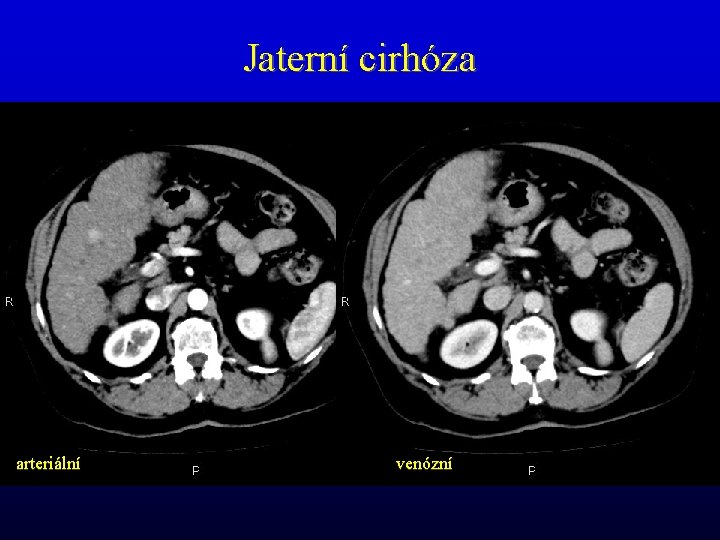 Jaterní cirhóza arteriální venózní 