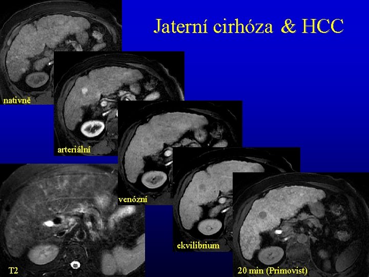 Jaterní cirhóza & HCC nativně arteriální venózní ekvilibrium T 2 20 min (Primovist) 