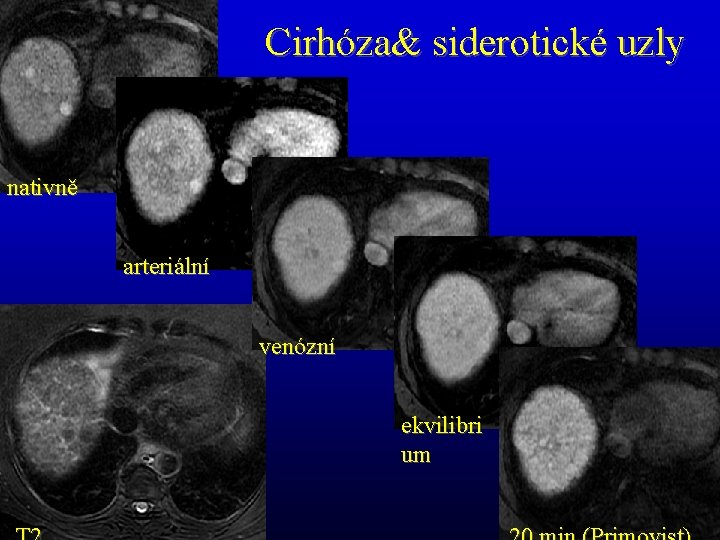 Cirhóza& siderotické uzly nativně arteriální venózní ekvilibri um 