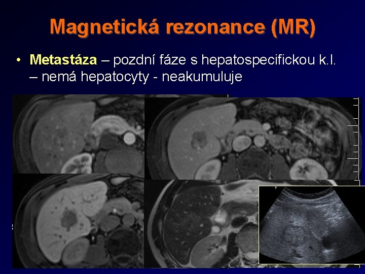 Magnetická rezonance (MR) • Metastáza – pozdní fáze s hepatospecifickou k. l. – nemá