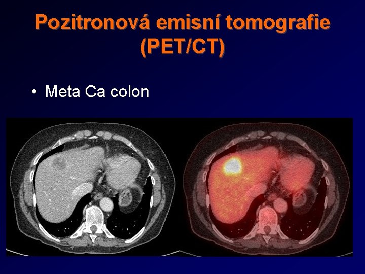 Pozitronová emisní tomografie (PET/CT) • Meta Ca colon 