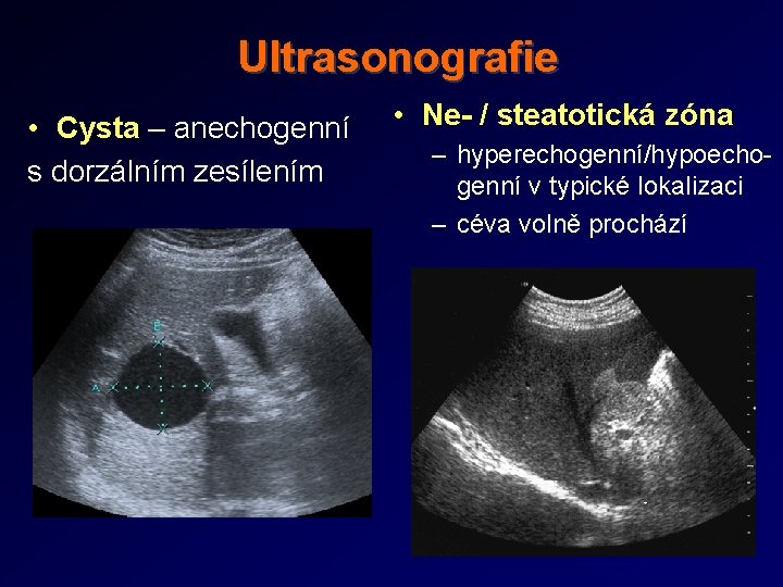 Ultrasonografie • Cysta – anechogenní s dorzálním zesílením • Ne- / steatotická zóna –