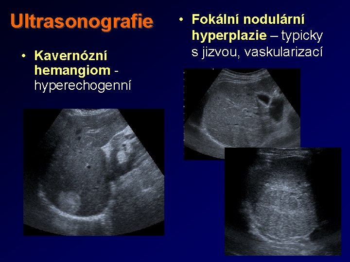 Ultrasonografie • Kavernózní hemangiom - hyperechogenní • Fokální nodulární hyperplazie – typicky s jizvou,