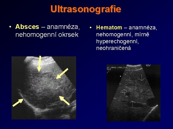 Ultrasonografie • Absces – anamnéza, nehomogenní okrsek • Hematom – anamnéza, nehomogenní, mírně hyperechogenní,