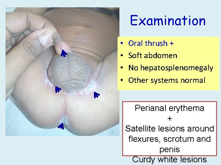 Examination • • Oral thrush + Soft abdomen No hepatosplenomegaly Other systems normal Perianal