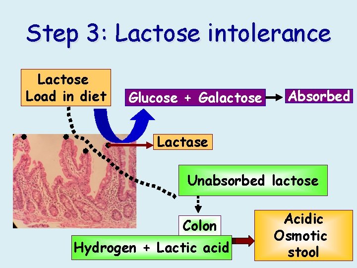 Step 3: Lactose intolerance Lactose Load in diet Glucose + Galactose Absorbed Lactase Unabsorbed