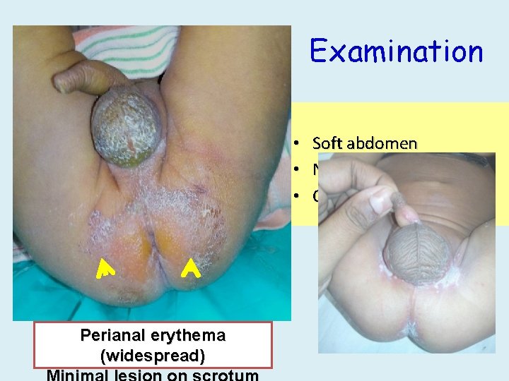 Examination • Soft abdomen • No hepatosplenomegaly • Other systems normal Perianal erythema (widespread)