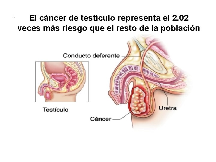 : El cáncer de testículo representa el 2. 02 veces más riesgo que el