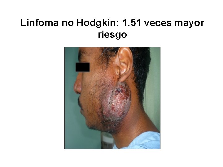 Linfoma no Hodgkin: 1. 51 veces mayor riesgo 