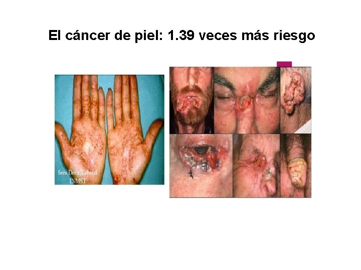 El cáncer de piel: 1. 39 veces más riesgo 