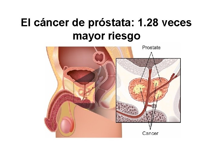 El cáncer de próstata: 1. 28 veces mayor riesgo 