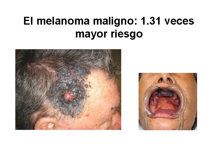 El melanoma maligno: 1. 31 veces mayor riesgo 