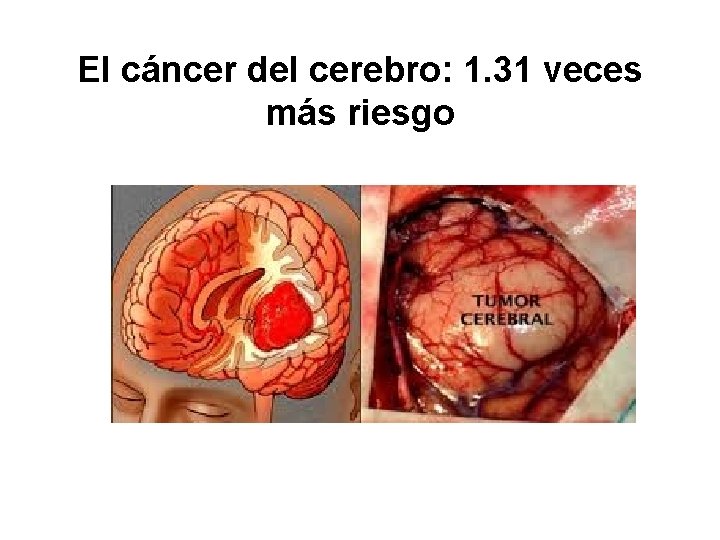 El cáncer del cerebro: 1. 31 veces más riesgo 