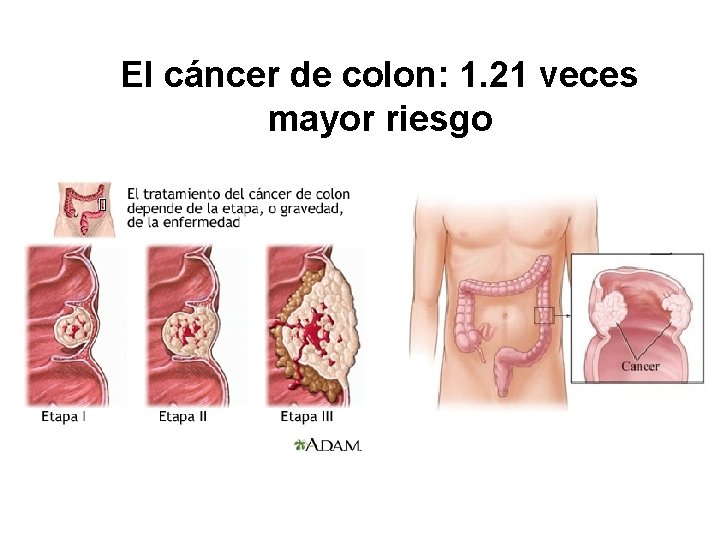 El cáncer de colon: 1. 21 veces mayor riesgo 