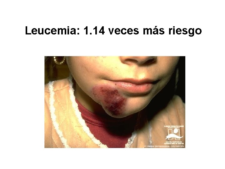 Leucemia: 1. 14 veces más riesgo 