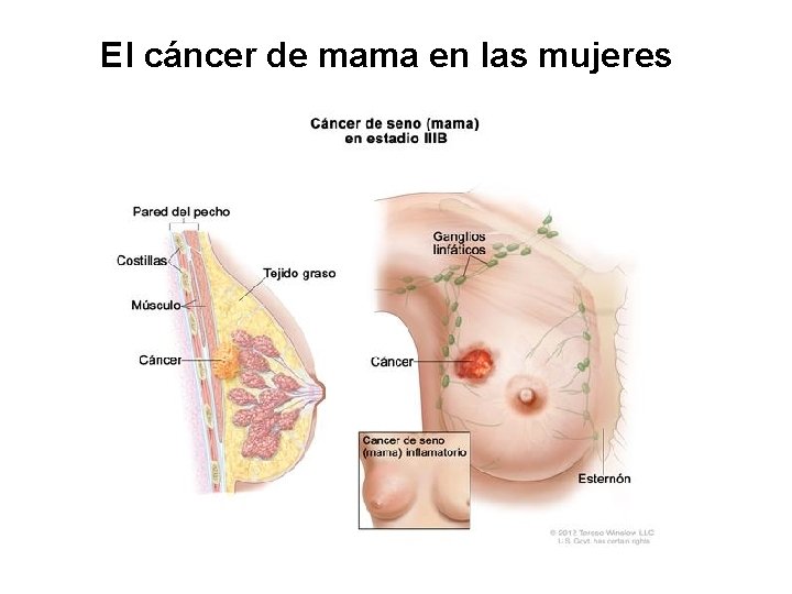 El cáncer de mama en las mujeres 