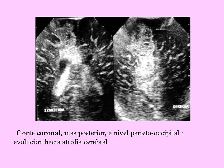 Corte coronal, mas posterior, a nivel parieto-occipital : evolucion hacia atrofia cerebral. 