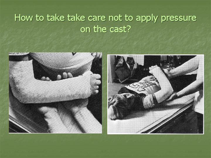 How to take care not to apply pressure on the cast? 