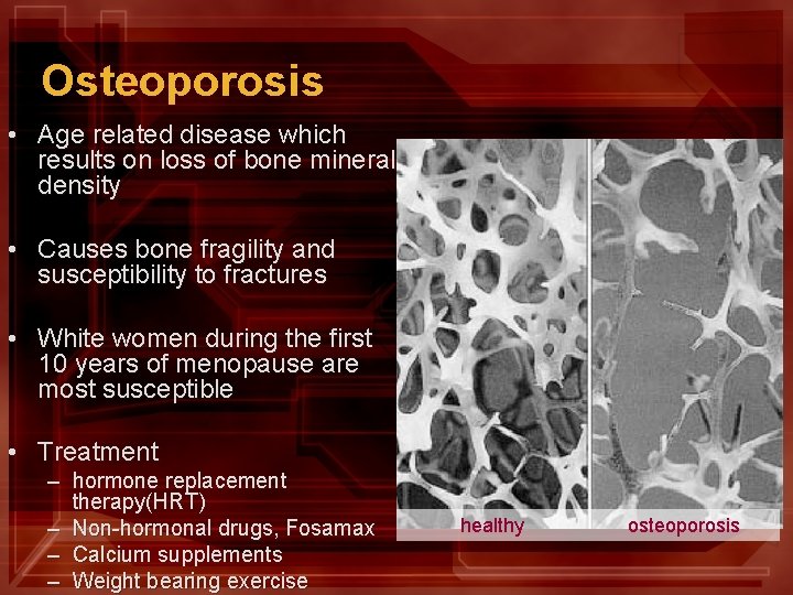 Osteoporosis • Age related disease which results on loss of bone mineral density •