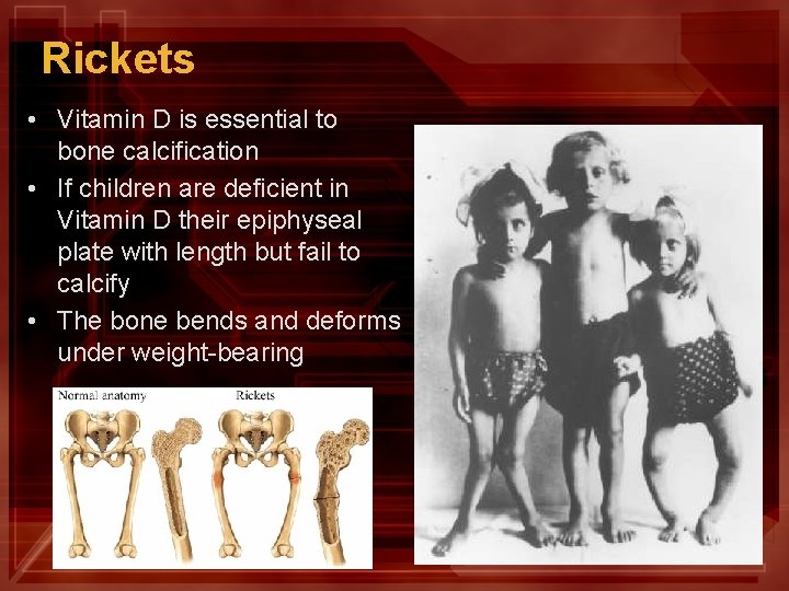 Rickets • Vitamin D is essential to bone calcification • If children are deficient