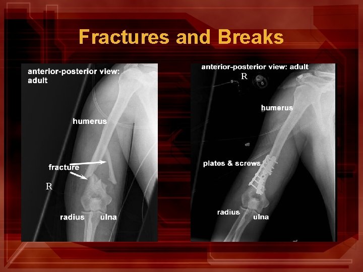 Fractures and Breaks 